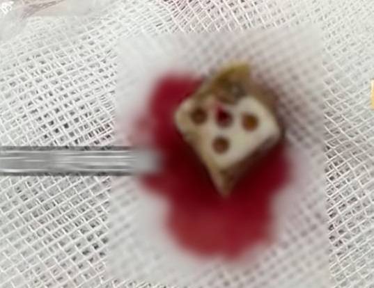 만성적인 재채기에 시달리던 한 청년의 코안에서 약 20년 된 주사위가 나왔다는 사연이 전해졌다./사진=SCMP