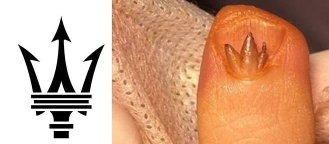 중국의 한 여성 손톱에 마세라티 모양의 육아조직이 생겼다.[사진출처=소후닷컴]