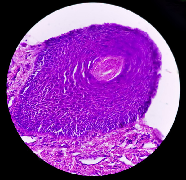 기저세포암(Basal cell carcinoma) 조직을 확대한 사진. /사진=게티이미지뱅크