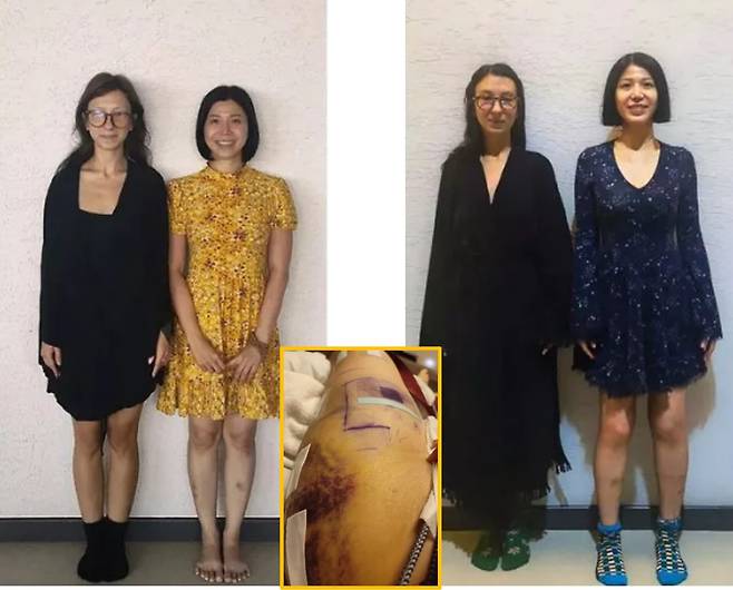 베트남에서 태어나 12살에 미국으로 이주해 캘리포니아에서 생활해 온 그는 키가 평균보다 작은 아시아계 여성으로서 느꼈던 불편함과 사회적 시선을 해결하고자 수술을 결심했다고 밝혔다. [사진=영국 일간 미러 보도]