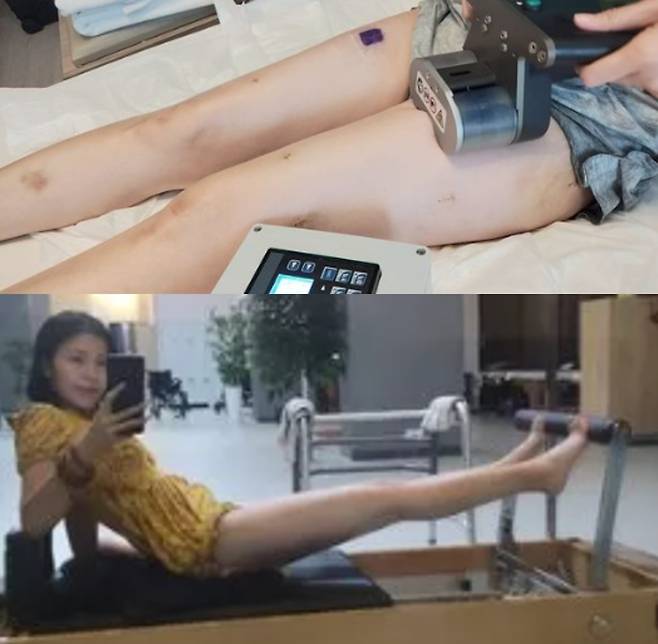 앤젤리나가 받은 Precice 2 시스템이라는 첨단 기술을 이용한 수술은 뼈 안에 금속막대(내부 고정 장치)를 삽입하는 방식이다. 외부 리모컨으로 뼈를 조금씩 늘리도록 설계돼 있다. [사진=영국 일간 미러 보도]