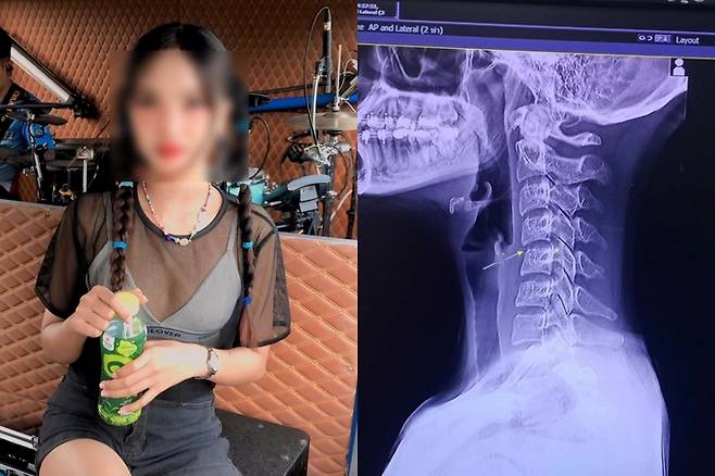 태국 전통 마사지를 받고 후유증으로 사망한 태국 가수 차야다 쁘라오 홈. 그가 올린 엑스레이 사진. /사진=페이스북 캡처