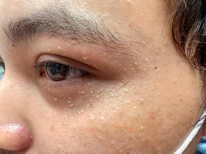 비립종은 1~2mm 크기의 작은 표재성 각질낭종이다. 피부 모공에 쌓인 피지와 노폐물이 뭉쳐 굳어져 만들어진 일종의 각질 주머니다. [사진=클립아트코리아]