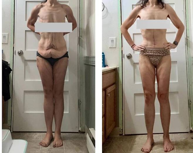 미국에선 GLP-1 계열의 체중 감량 약물로 인해 살이 급격히 빠진 사람이  늘면서 피부 성형이 크게 늘었다.  러셀의 수술하기 전 모습(왼쪽)과 수술 이후의 모습. 수술로 복부의 늘어진 피부가 사라진 것을 볼 수 있다.[CNN 캡쳐]