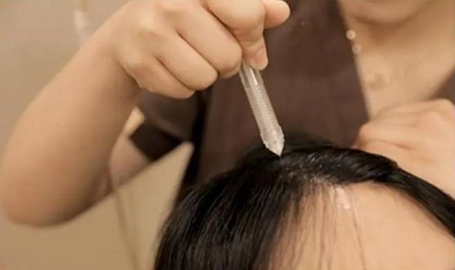 탈모 전문 병원에서 진행하는 ‘메조테라피’. 모제림성형외과 제공