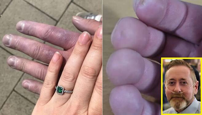 스콧 넬(47)은 추위에 손가락이 하얗게 변하는 증상을 겪고 극심한 피로감, 호흡 곤란 등을 겪었다. 이후 병원을 찾은 그는 손가락 끝에 칼슘침전물이 쌓여 있는 상태임을 확인했고, 전신경화증이라는 진단을 받았다. 전신경화증은 피부, 혈관, 내부 장기가 두꺼워지거나 딱딱해지는 병이다. [사진=영국 매체 더 선 보도 갈무리]