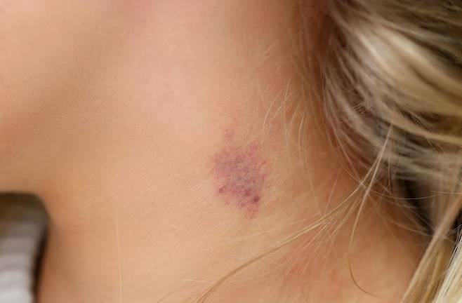 키스 마크로 인해 경동맥에 혈전이 생겨 뇌경색이 유발할 수 있다./사진=게티이미지뱅크