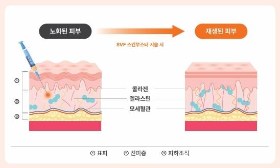 SVF스킨부스터시술과정