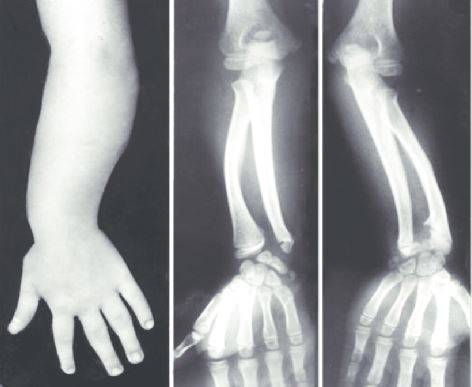 뼈 변형이 일어난 레리-웨일 증후군 환자 팔을 스캔한 사진/사진=Restricted Growth - Clinical, Genetic and Molecular Aspects