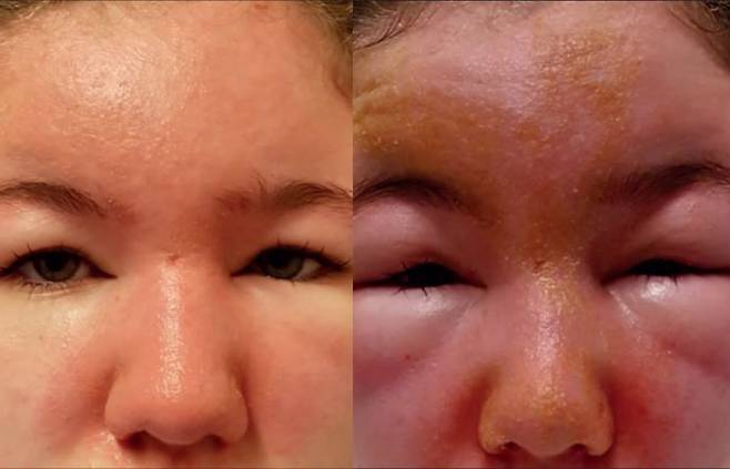 과산화벤조일(BPO) 여드름 연고를 바르고 얼굴이 부어 응급실을 찾았지만 증상이 더욱 극심해졌던 12세 소녀의 얼굴. 출처= Ulster Medical Society