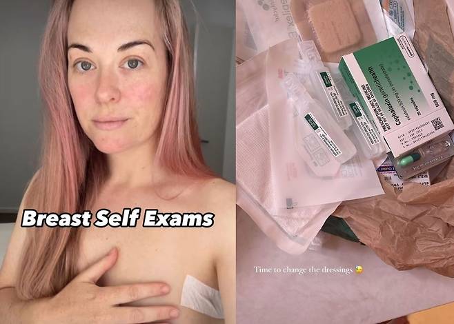 단순히 가슴에 습진이 생긴 줄 알았으나 유방암의 일종인 ‘유방 파제트병’ 진단을 받은 호주 여성 엠 데이비의 모습(왼)과 치료를 위해 사용한 약물(오)의 모습/사진=데일리 메일