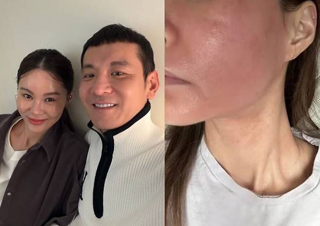 경맑음이 비타민C 앰플을 바르고 알레르기를 겪었다고 밝혔다. [사진=경맑음 SNS]