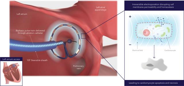 심장의 각 조직은 서로 다른 전기장 강도를 갖는다. 펄스장 절제술(PFA·Pulse Field Ablation)은 교대로 양극과 음극 전극을 사용하면 카테터 주변에 양극성 전기장이 형성되어 조직으로 확장되는 원리를 이용해 심방세동을 치료하는 최신 중재시술이다. 전기장이 세포막 투과성을 증가시키면 세포기능장애를 유발하고 그 결과 타깃하는 심근세포만 사멸시킬 수 있다. 자료·사진 제공=미국심장학회 공식 학술지 'Circulation' 2023년 5월호 발표 논문