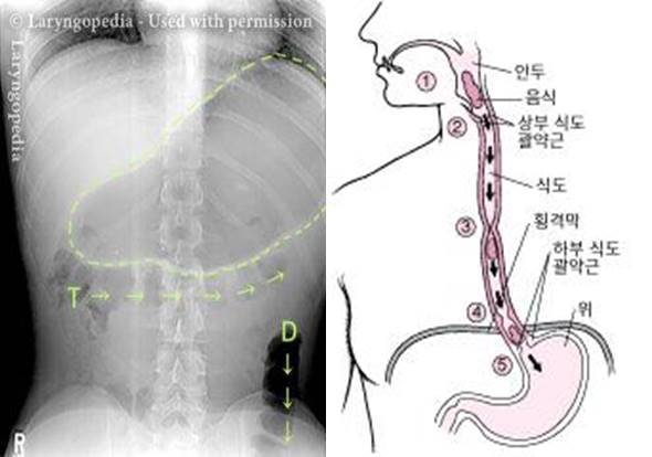 역행성 윤상인두근 기능장애로 인해 트림을 하지 못하면 위가 팽창하여 과도한 복부 팽만감을 일으킬 수 있다./사진=Laryngopedia By Rober W Bastian, MD, MSD 매뉴얼