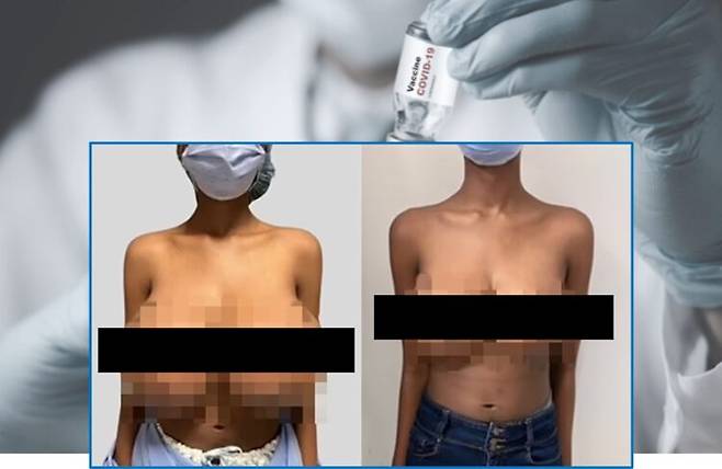 캐나다에 사는 19세 여성이 코로나19 백신 접종 후 6개월 만에 가슴 크기가 B컵에서 트리플 G컵으로 증가하는 사례가 보고됐다. 왼쪽이 백신 접종 후 트리플G컵으로 커진 모습, 오른쪽이 축소술 받은 후 D컵으로 작아진모습[사진= 배경 게티이미지뱅크 / 여성 사진=Plastic & Reconstructive Surgery-Global Open]