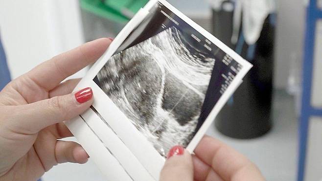 배아 이식 당일 초음파 사진