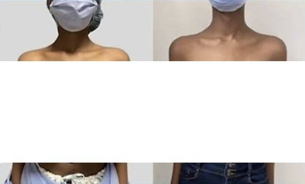 백신 접종 후 트리플G컵으로 커진 모습(좌), 축소술 받은 후 D컵으로 작아진 모습(우). 사진=Plastic & Reconstructive Surgery-Global Open 갈무리