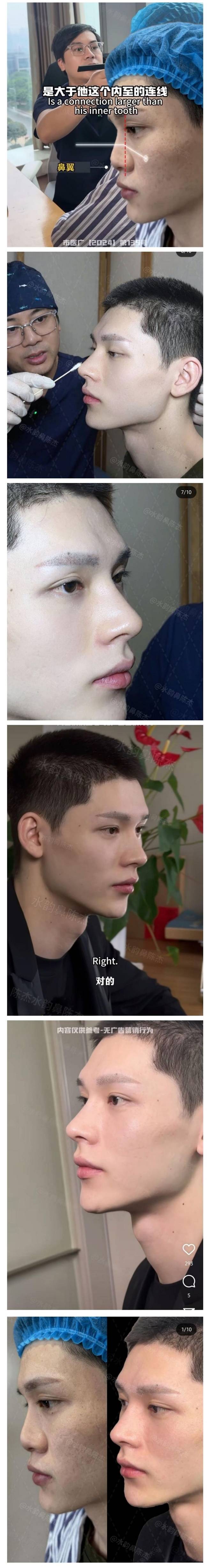 남자 코 성형수술 후기jpg