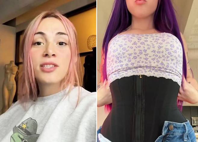 허리를 잘록하게 만들기 위해 갈비뼈 6개를 제거한 미국 트랜스젠더 여성 에밀리 제임스의 모습(왼)과 갈비뼈 제거 후 코르셋을 착용한 모습(오)/사진=뉴욕포스트