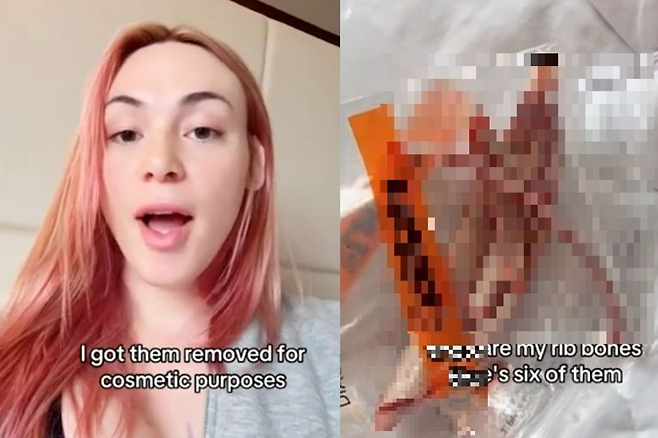 갈비뼈 6개를 제거한 미국 트랜스젠더 여성 에밀리 제임스. 오른쪽 사진은 그가 공개한 제거된 갈비뼈. [뉴욕포스트]