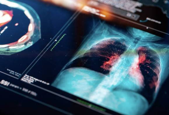 폐 질환 진단 관련 사진. 기사 내용과 무관함. [사진=픽사베이 ]