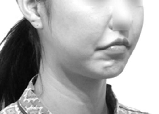 인중축소술 후 입꼬리가 떨어지고 입을 닫기 어려워진 모습.