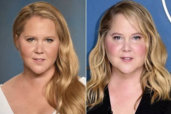 배우 에이미 슈머(43)가 악플 덕분에 쿠싱 증후군을 알아차렸다고 밝혔다. 슈머의 원래 모습과 작년 쿠싱 증후군 때문에 얼굴이 부은 모습./사진=피플