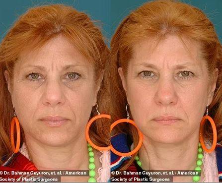 진(왼쪽)과 자넷/사진=American Society of Plastic Surgeons