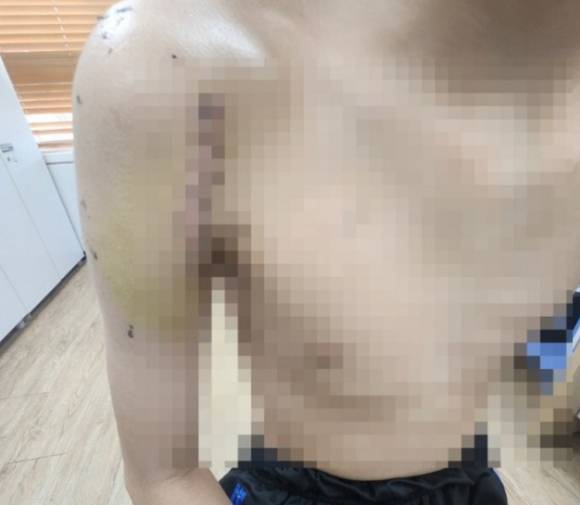 충남의 한 초등학교 6학년 A군은 자신에게 학교폭력을 저지른 가해자 B군과 같은 중학교에 배정됐다. 사진은 B군에게 폭행당한 후 어깨 수술을 한 A군 상태. [사진=연합뉴스, 독자제공]