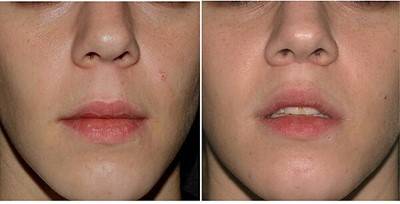 입술 거상술 (lip lift). [사진=영문위키 백과]