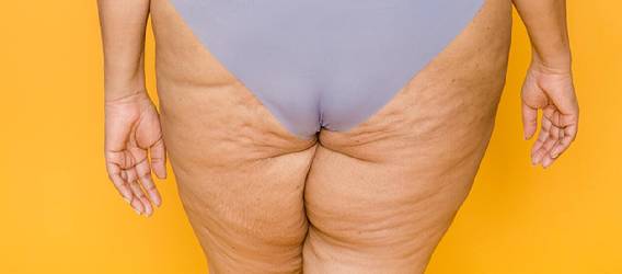 셀룰라이트가 생기는 가장 큰 원인은 체내의 순환이 제대로 이루어지지 않기 때문이다. [사진=pexels]