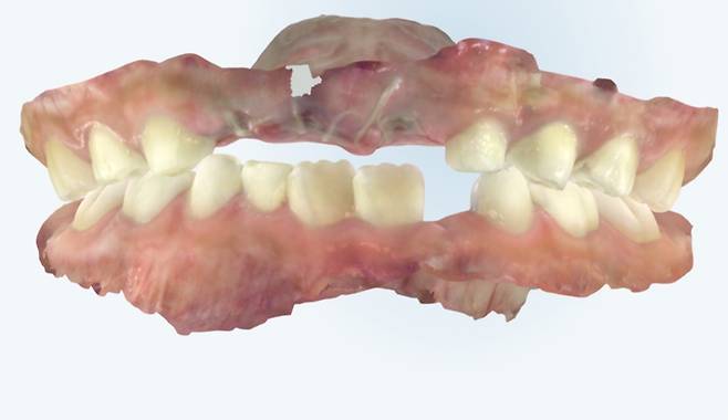 유치가 빠져 병원에 내원한 아이의 구강 스캔 이미지. /사진=서울성모병원
