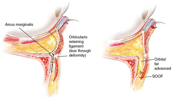 눈 밑 고랑을 만드는 유지 인대(retaining ligament)를 풀고, 꺼진 부위로 지방을 내려 채워주는 방식의 '눈밑지방재배치'가 널리 시행되고 있다. [사진=Plastic Surgery Key (Illustration of William Winn)]