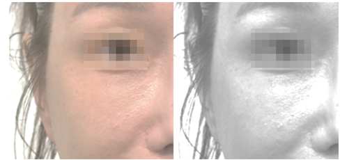 지방을 끌어내리기만 한 '지방재배치'에서 재수술로 '격막강화'를 추가로 시행한 모습.