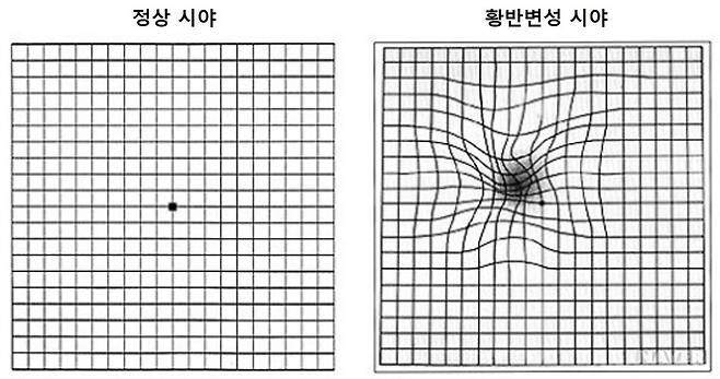 황반변성 자가 검사에 사용하는 암슬러 격자. 서울대병원 제공