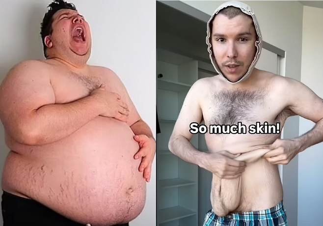 체중 감량 전과 후/ 처진 살을 다 제거하겠다고 밝힌 니코카도 아보카도 [사진=Nikocado Avocado 유튜브]