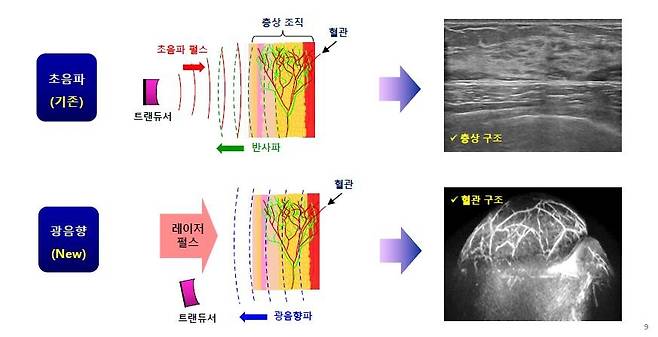 기존 초음파 내시경과 광음향 초음파 내시경 영상의 차이 [비달소닉 제공. 재판매 및 DB 금지]