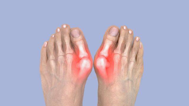 통풍은 급성 발작기와 간헐기가 있다 ｜출처: 클립아트코리아