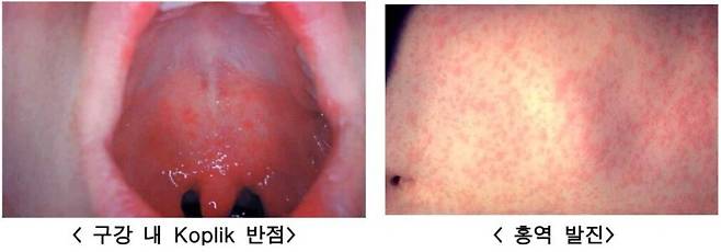홍역은 급성 발진성 바이러스 질환으로 전염성이 매우 높다. 홍역에 걸리면 초기에 감기처럼 기침, 콧물, 결막염 등의 증상이 나타나고, 고열과 함께 얼굴에서 시작해 온몸에 발진이 나타난다. 미국질병관리본부