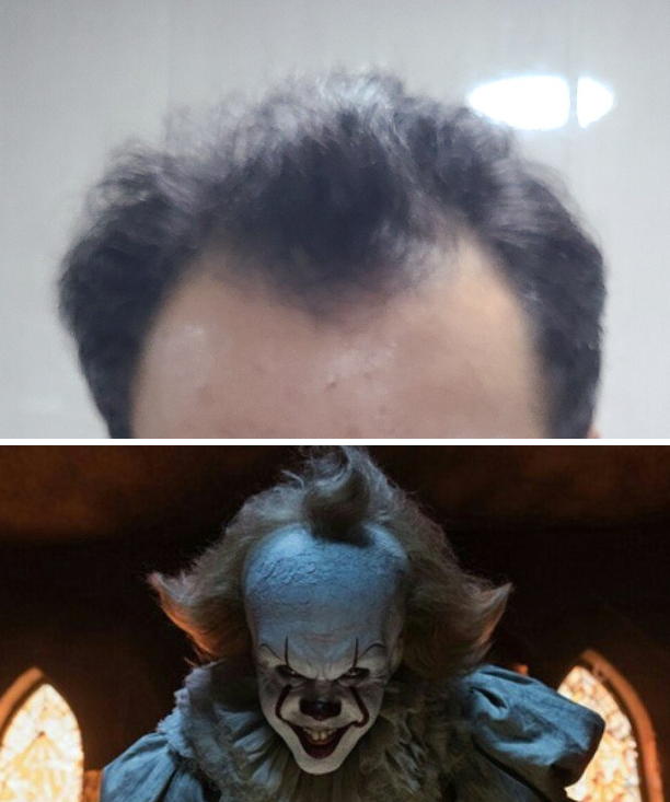 before.png 펨붕이 탈모약 3개월 복용 후기.(마지막)