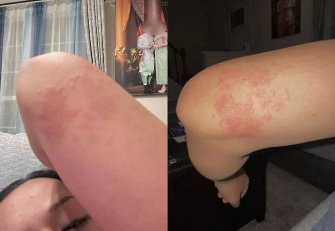 백선증에 감염된 40대 여성 삼낭.ⓒ더 선