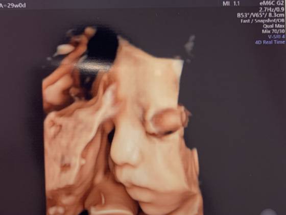 태명은 '나무'였다. 단단하기를, 뿌리가 깊기를, 사계절 다른 이파리처럼 다채롭기를. 임신 29주차 초음파 사진에서 그윽한 얼굴을 보여준 나무. 실물은 비슷하지만, 인상을 훨씬 더 자주 쓴다./사진=아빠 얼굴보단 예쁜 엄마 닮길 바랐던 남형도 기자