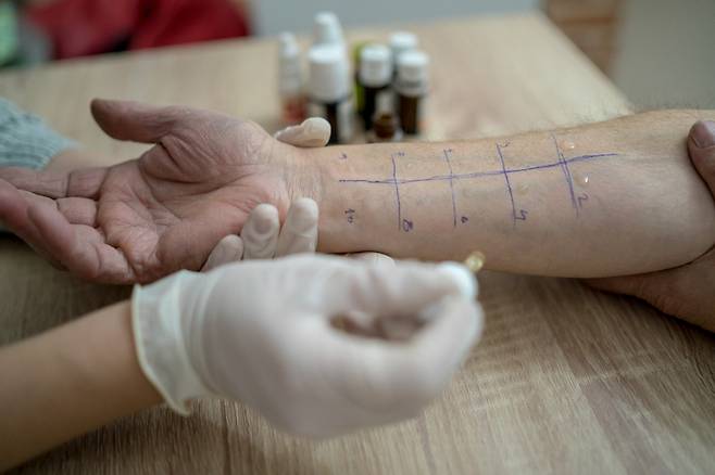 알레르기 유발 물질을 찾기 위한 피부 테스트.