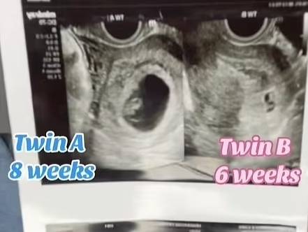 임신중 임신으로 두 아이를 임신한 미국 여성 테일러 헨더슨. [인스타그램]