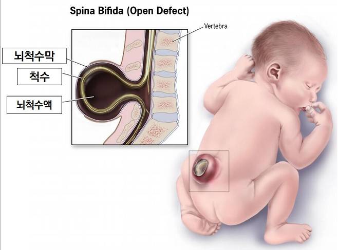 김상우 연세대 의대 교수 연구진이 척추이분증의 유전적 원인을 찾아냈다. 이미지는 척추이분증을 가진 신생아./김상우