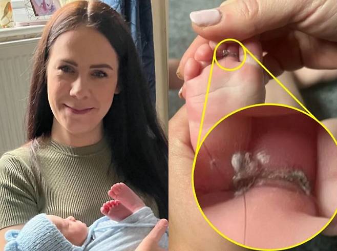 영국의 한 5개월 아이가 발가락에 머리카락이 엉킨 후 절단할 뻔한 사연이 공개됐다./사진=더 선