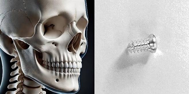 두개·악안면(CMF)에 적용되는 세계 최초 생체흡수성 마그네슘 합금 기반 '스텔스픽스(StealthFix™ CMF Screw)' [시지메드텍 제공]
