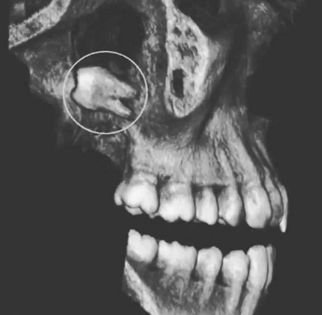 Screenshot_20250329_194605_Instagram.jpg 인류 역대 최악의 사랑니 발생 위치