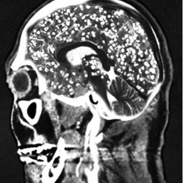 '돼지고기 촌충'이라 불리는 갈고리촌충의 유충은 혈액을 타고 뇌에 침범해 두통과 발작을 일으키기도 한다. /사진= 유튜브 Chubbyemu]