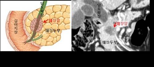 췌장암 CT 영상 [분당서울대병원 제공]